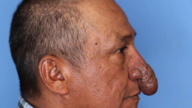FOTO Transformarea incredibilă a unui bărbat căruia nasul i-a crescut exagerat de mult: „Îmi ajungea la buze” - Imaginea 6