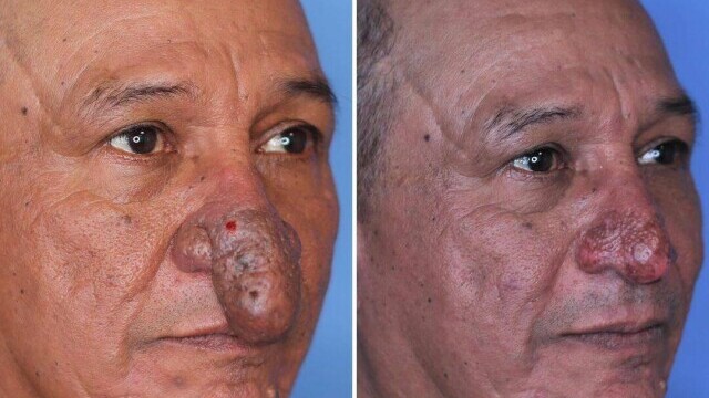 FOTO Transformarea incredibilă a unui bărbat căruia nasul i-a crescut exagerat de mult: „Îmi ajungea la buze” - Imaginea 4