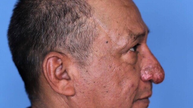 FOTO Transformarea incredibilă a unui bărbat căruia nasul i-a crescut exagerat de mult: „Îmi ajungea la buze” - Imaginea 3