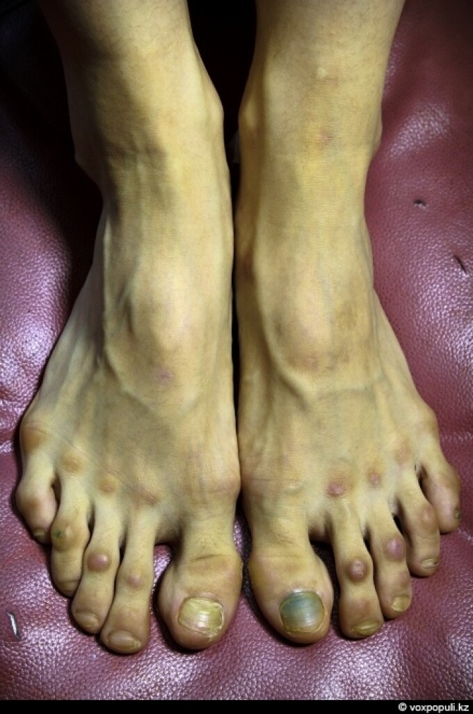 picioare balerina varicosa)