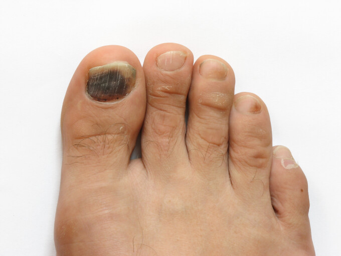 ciuperca neagra pe unghie complex pentru tratamentul ciupercii unghiilor de la picioare