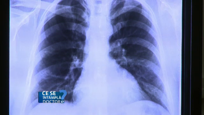 radiografie pulmonara pret)