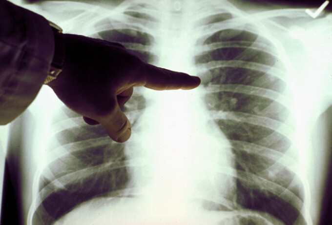 Cancerul pulmonar: cel mai mortal tip de cancer din lume | andreea-radu.ro