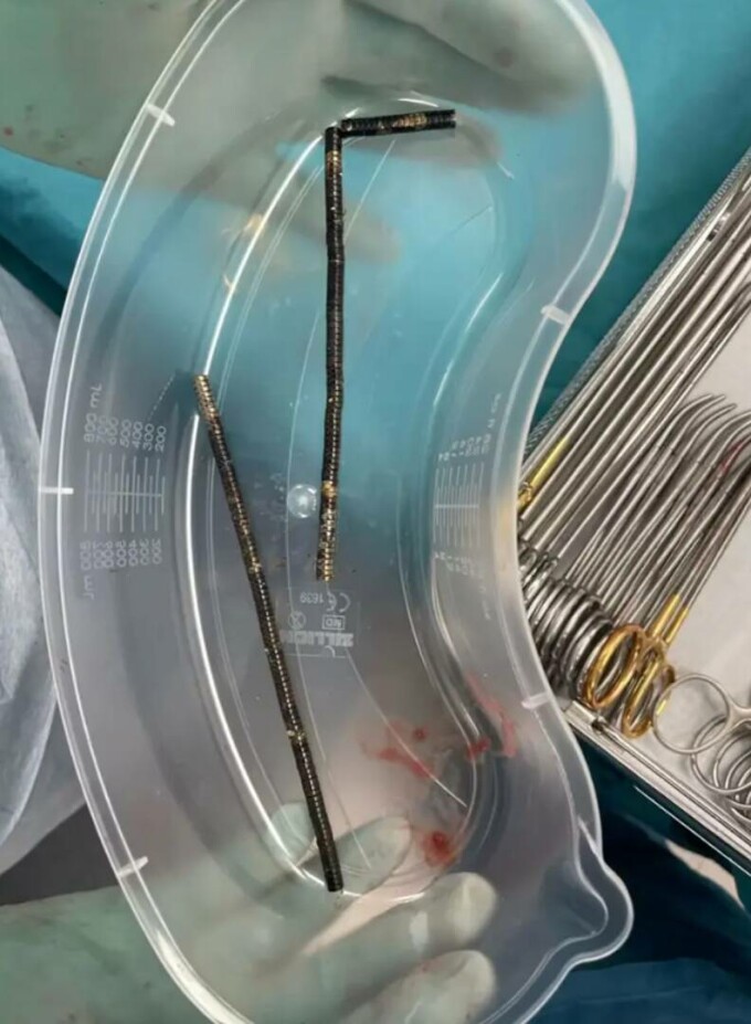 a înghițit peste 100 de magneți