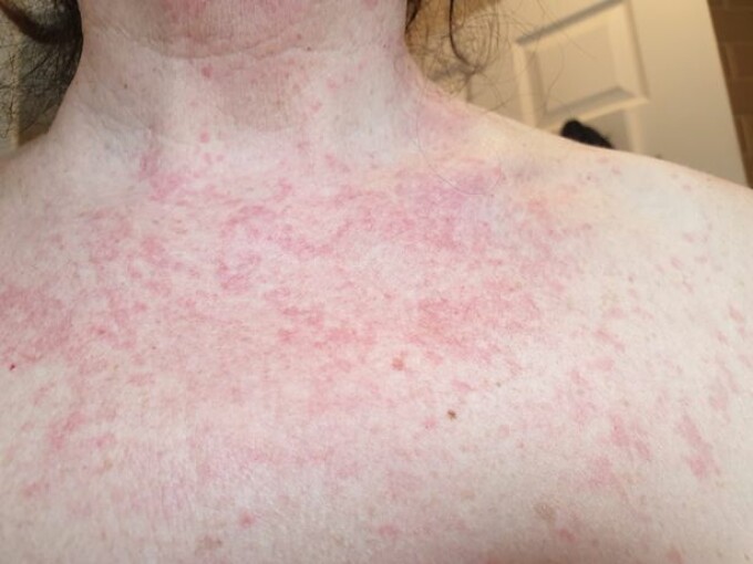 Alergiile: cauze, manifestari, ce simptome au, testare si cum le tratezi | Bioclinica