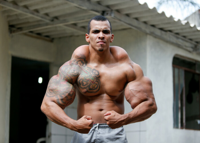 Brazilianul dependent de injectii cu ulei, poreclit Incredibilul Hulk, isi spune povestea