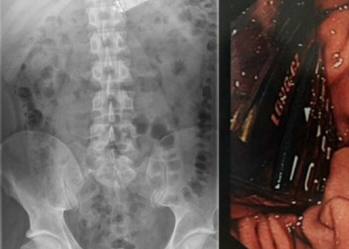 Ce au gasit gardienii in stomacul unui detinut dintr-o inchisoare irlandeza. L-au dus de urgenta la spital