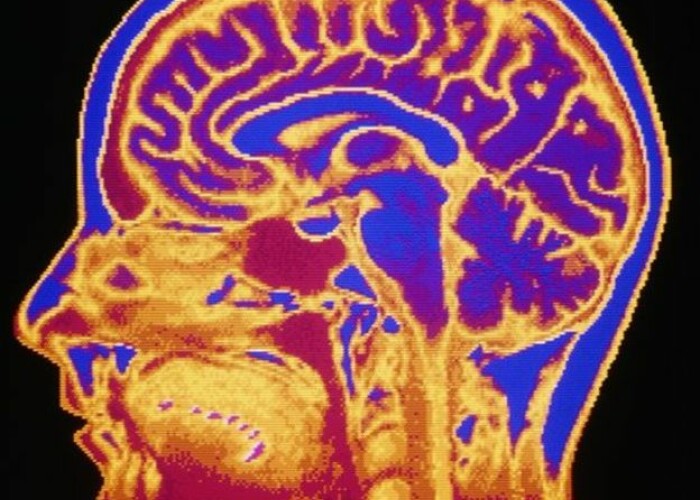 Studiu: creierul barbatului imbatraneste mai repede decat cel al femeii. Parkinsonul, mai frecvent printre reprezentantii sexului tare