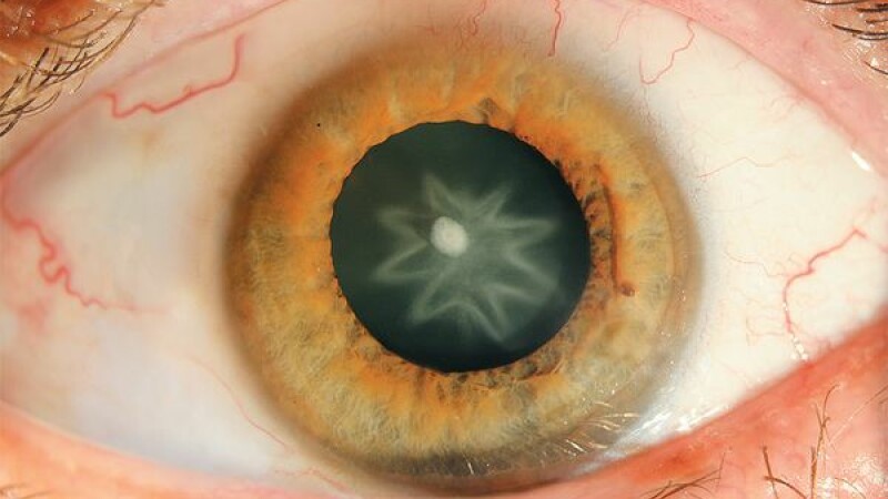 Cataracta