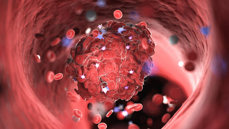 Cauzele cheagurilor de sânge, care pot duce la deces și în cazul COVID. De ce nu se dă „la liber” tratament anticoagulant
