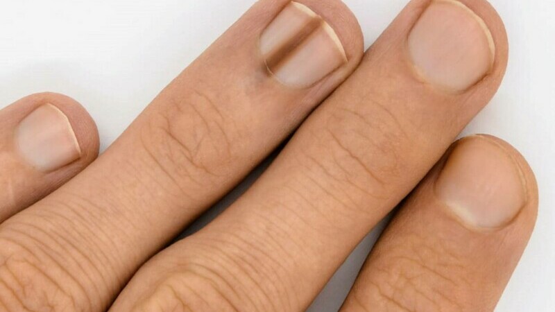 A crezut că e doar o dungă cool pe unghie, dar doctorii au decis de urgență să-i taie degetul. Ce avea această femeie