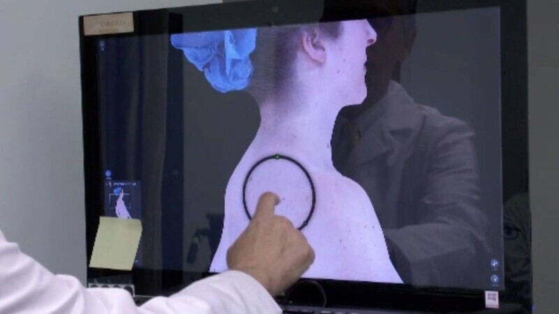 Cancerul de piele, depistat în câteva minute cu noile tehnologii. Înainte dura și patru ore