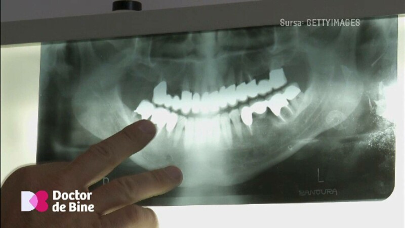 dinti radiografie