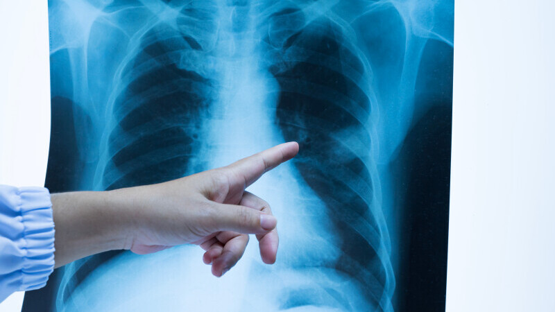 Cum pot fi depistate și evaluate leziunile pulmonare lăsate de infecția COVID-19?