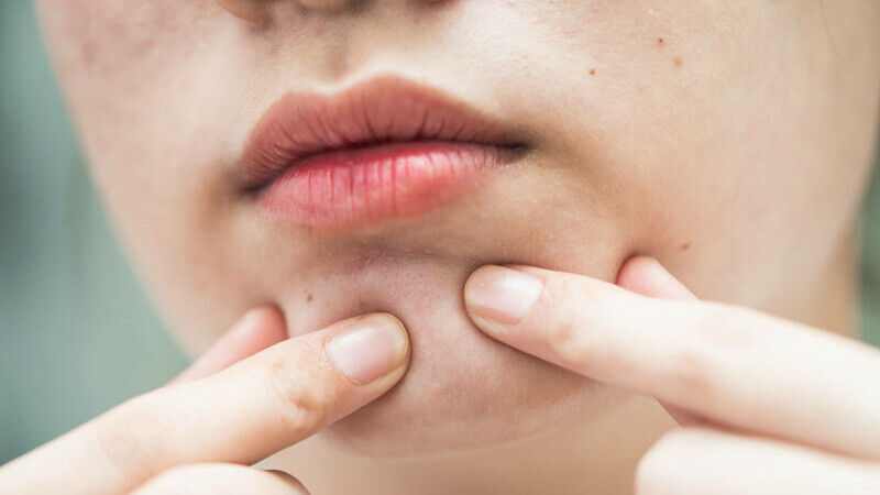 glande sebacee
