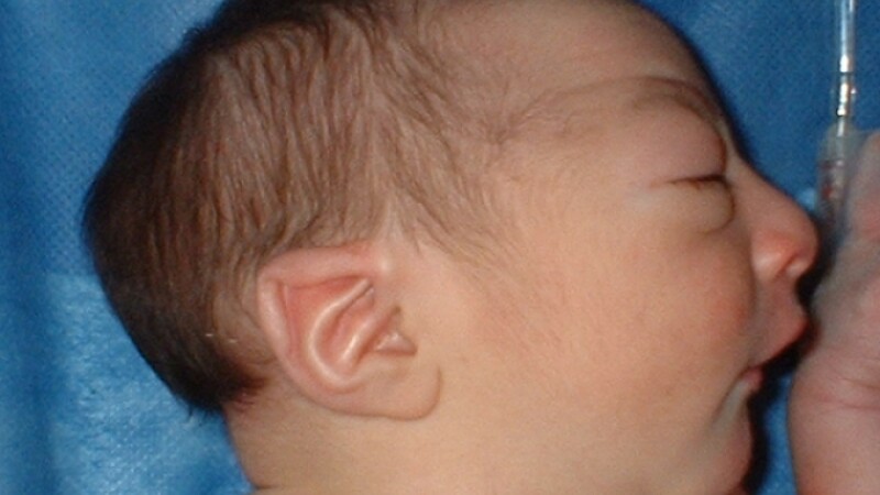 copil cu microcefalie
