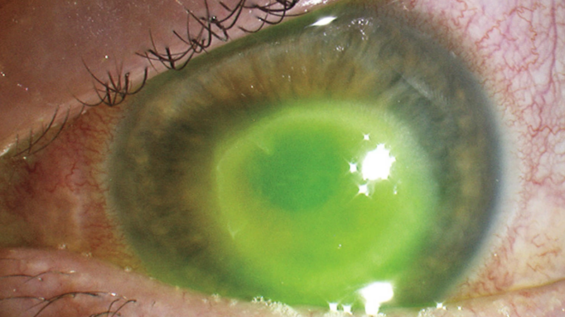 ochi infectat cu keratita amibiana
