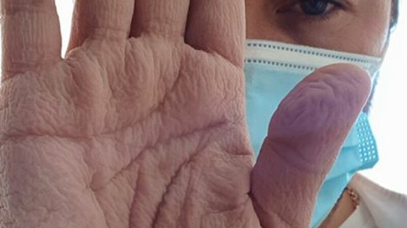 Așa arată mâna unui chirurg după o operație de 4 ore, la aproape 30 de grade. Cum a salvat în ultima clipă viața unui om