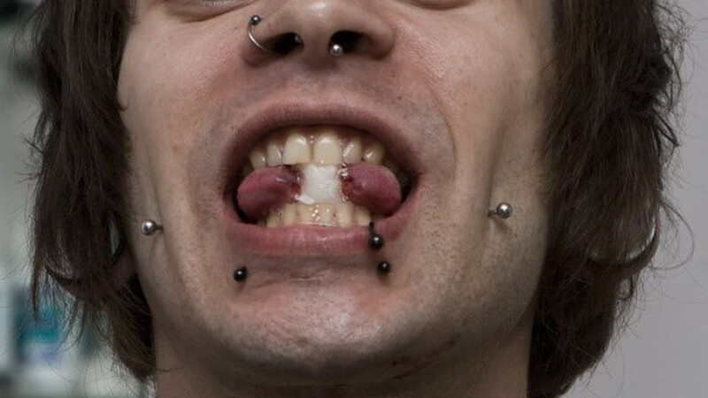 mutilati