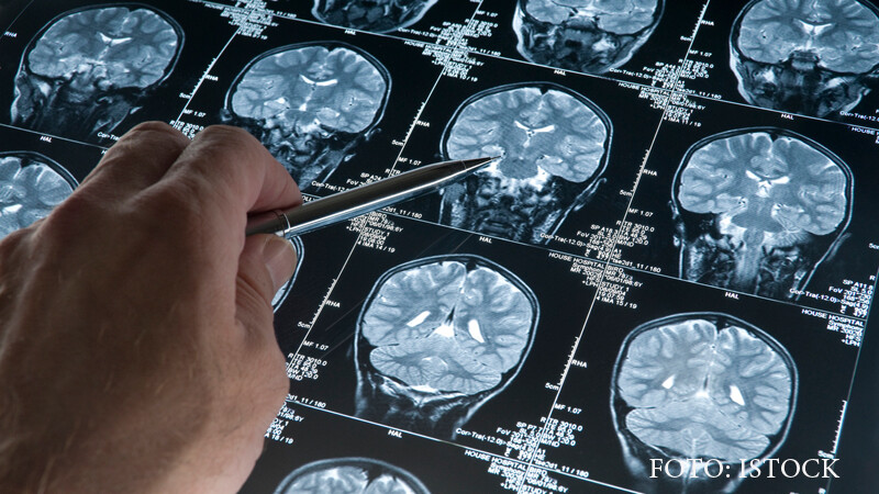 EEG, scanare a creierului