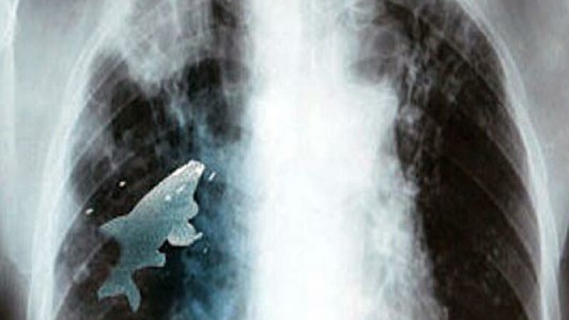 Radiografie peste