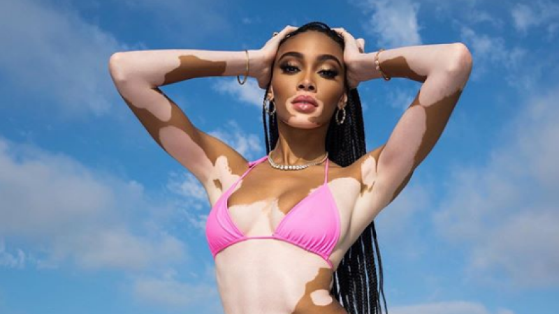 Winnie Harlow