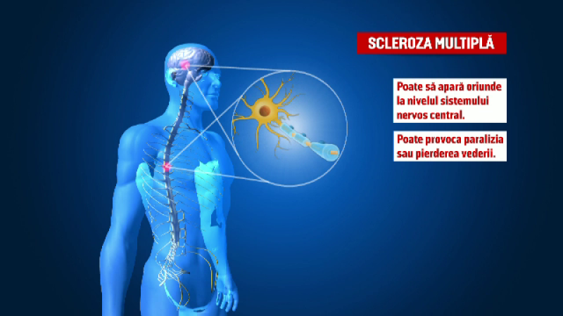 scleroza multipla