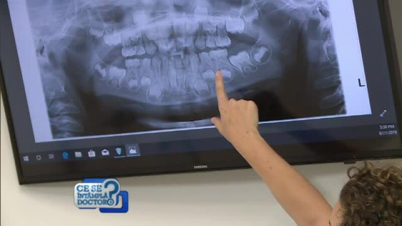 radiografie dinti