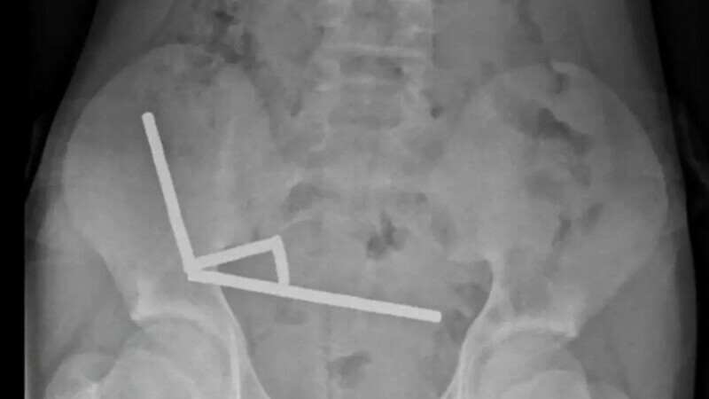 a înghițit peste 100 de magneți