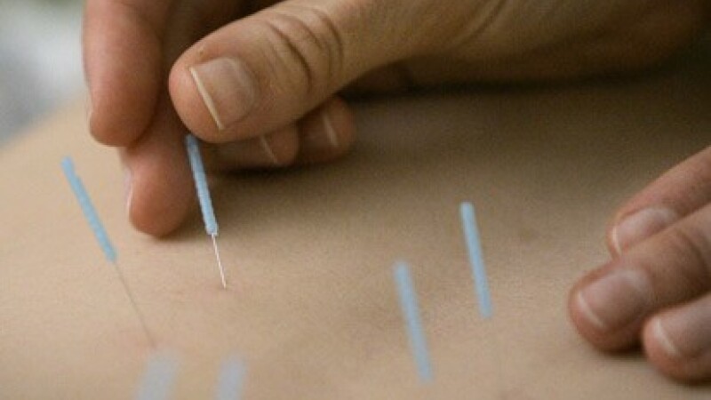 Acupunctura