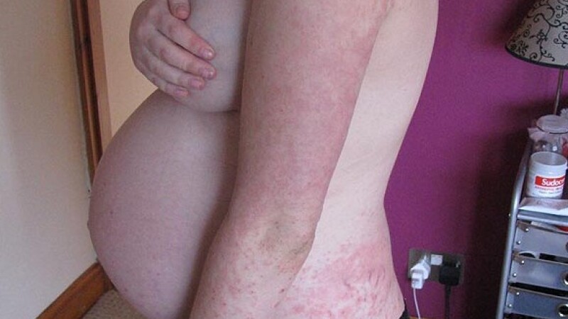 gravida cu eruptie pe piele, alergie