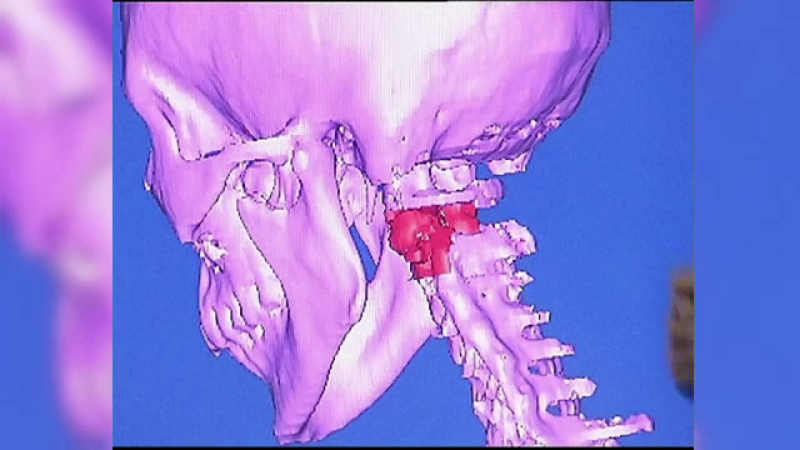 vertebra 3D