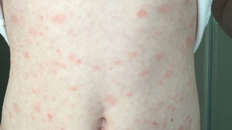 Cinci afecţiuni ale pielii, asociate cu noul coronavirus. Avertismentul emis de cercetători