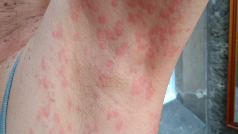 Dermatita alergica de contact