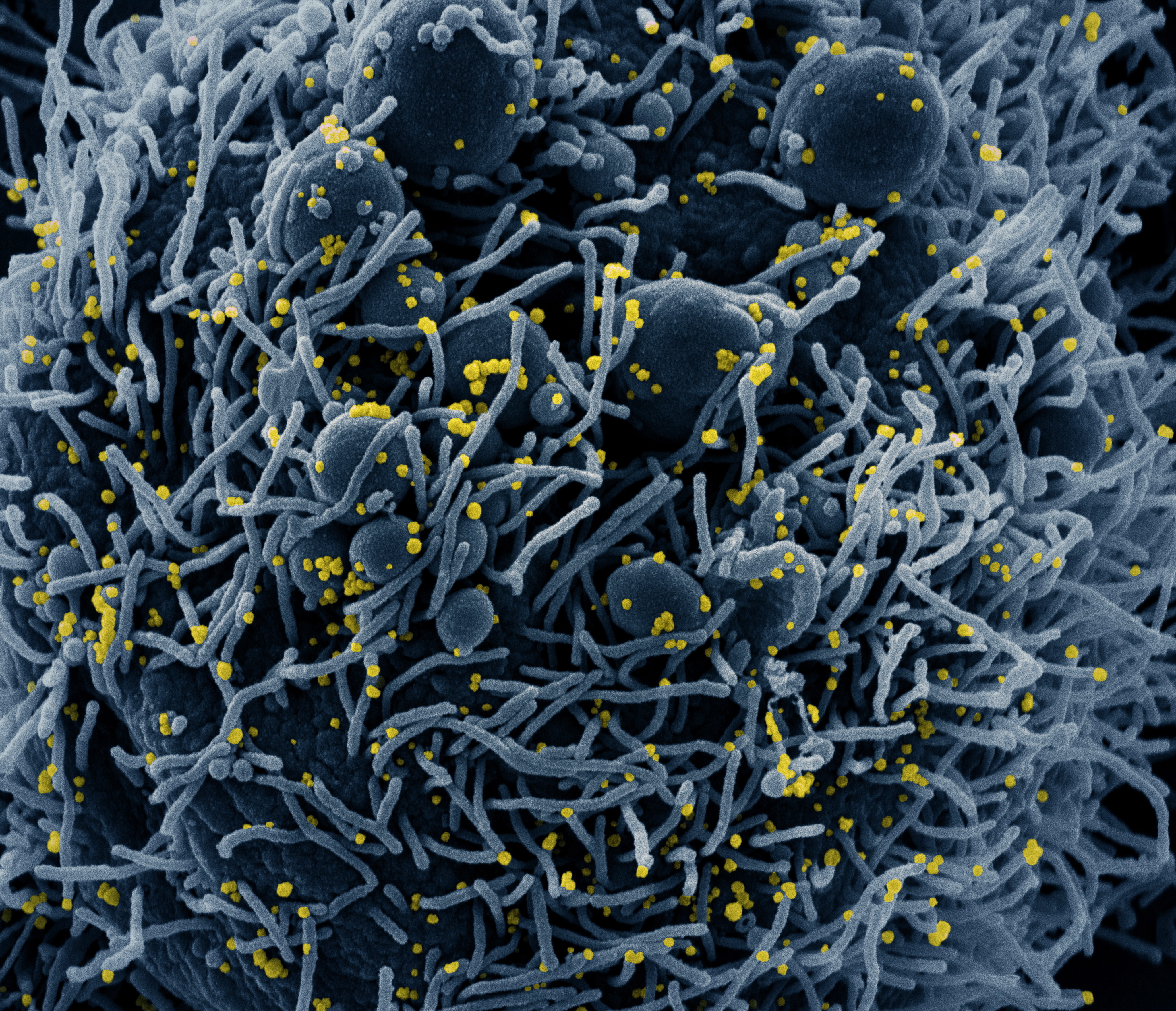 Imagini inedite cu noul coronavirus la microscop. Cum arată acum virusul care a făcut ravagii în lume. GALERIE FOTO