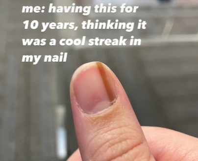 VIDEO O femeie a avut timp de 10 ani o dungă maro pe unghie. Medicul i-a dat un diagnostic șocant