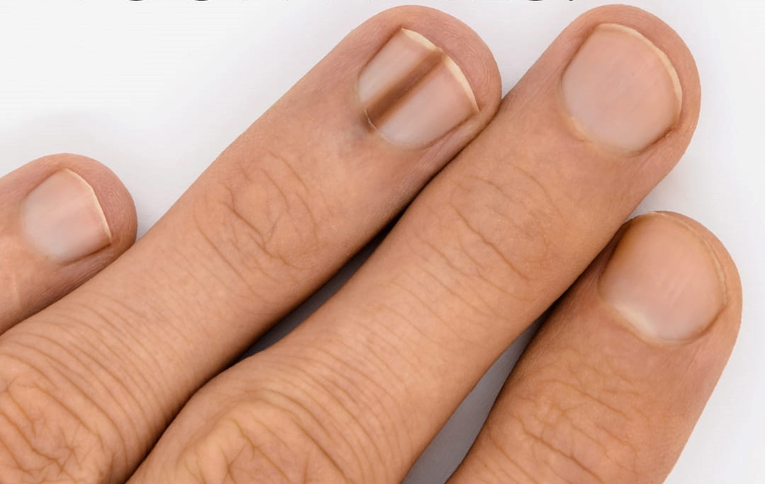 A crezut că e doar o dungă amuzantă pe unghie, dar doctorii au decis să-i taie de urgență degetul. Ce avea această femeie