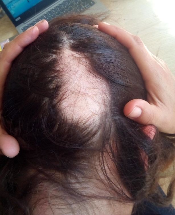 O femeie și-a pierdut o mare parte din păr din cauza COVID-19: 