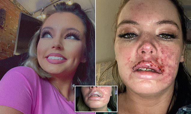 O americancă a fost aproape să își piardă buza superioară după o injecție cu botox