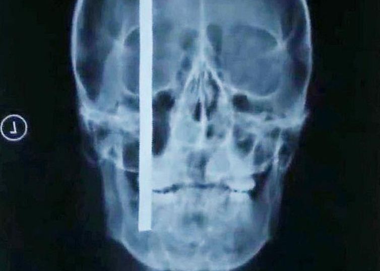 Accidentul care i-a uimit pe medicii chinezi: barbatul cu o bara de otel in cap
