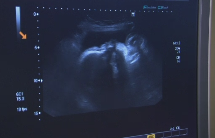 Premiera medicala mondiala: O femeie a nascut dupa ce i s-au transplantat tesuturi ovariene proprii prelevate in copilarie