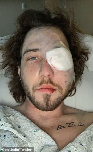 Un tânăr din SUA a rămas fără un ochi după ce a fost lovit de o grenadă a poliției - Imaginea 2