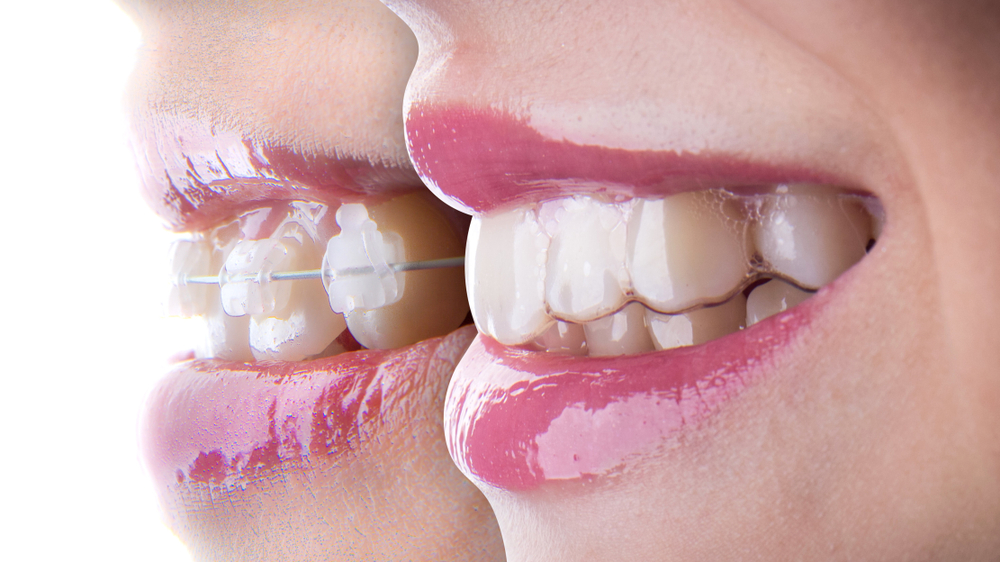 (P) Top beneficii ale aparatului dentar Invisalign
