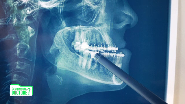 Ne putem pierde dinții din cauza traumatismelor, cariilor și bolii parodontale. Cum ne tratăm