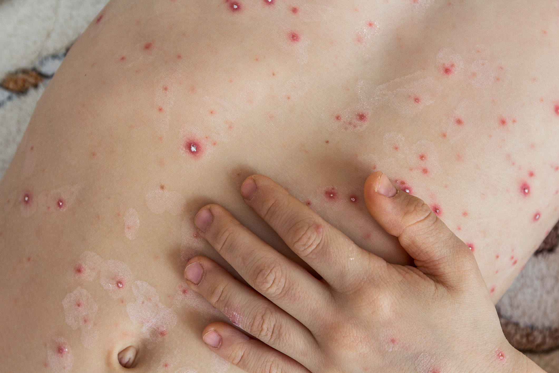 Tot mai mulţi pacienţi cu varicelă în Timiş. În ultimii doi ani nu a fost înregistrat niciun caz