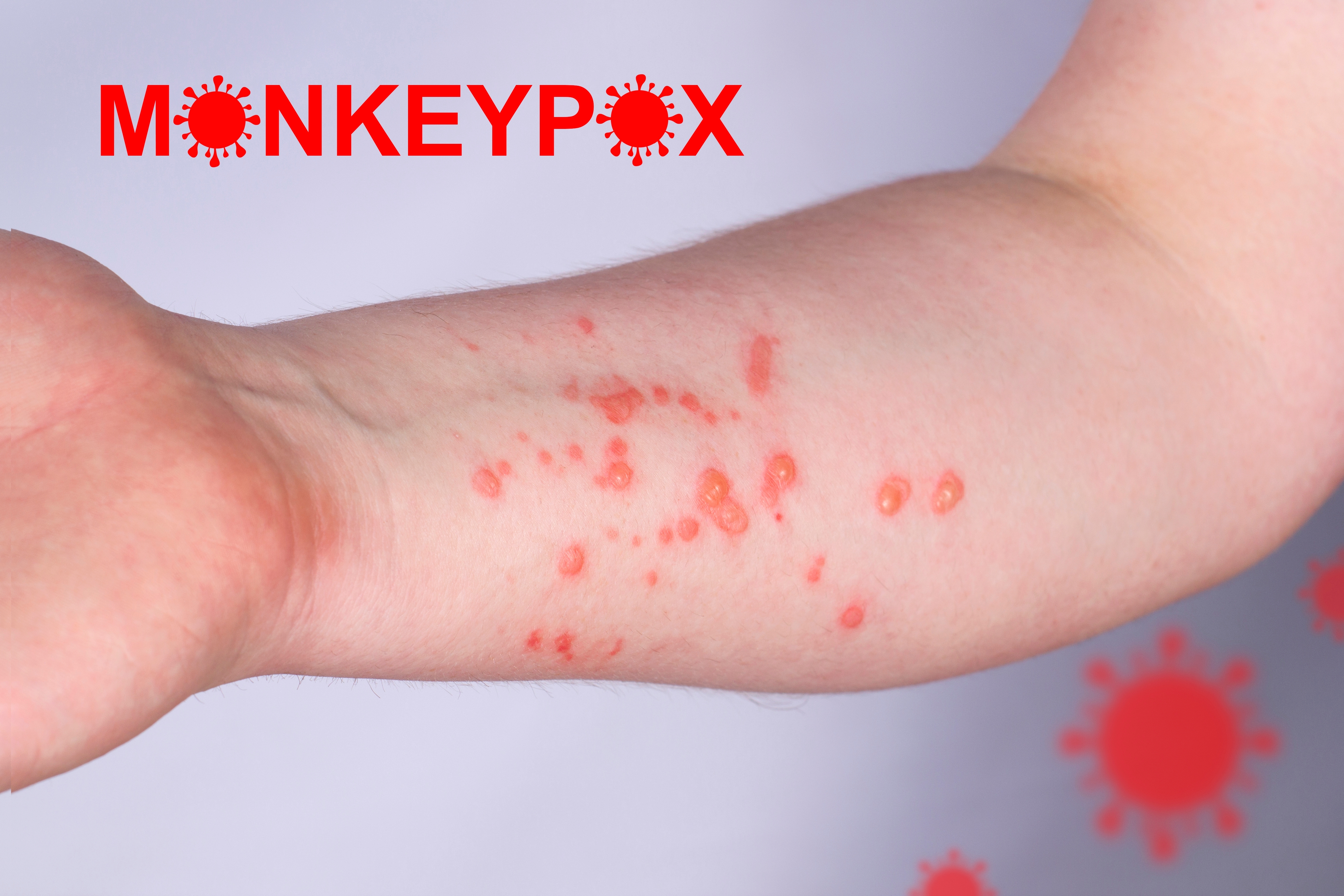 CDC a ridicat nivelul de alertă privind variola maimuței. Când este recomandată purtarea măștii de protecție