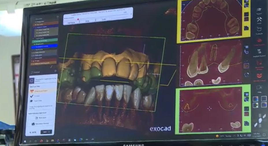 Cum se creează dinții perfecți cu ajutorul tehnologiei 3D. Perioada de adaptare a pacientului este mai mică