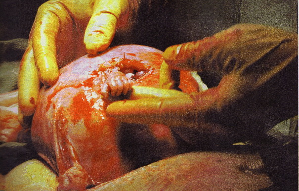 Povestea celei mai impresionante imagini. Cum arata acum fatul care a strans din uter mana medicului
