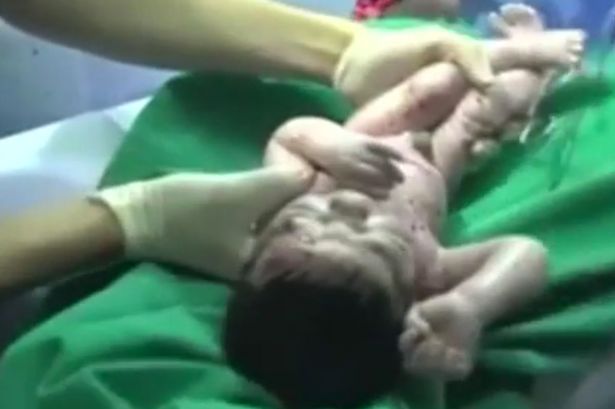 Imagini incredibile. Femeie supusa de urgenta unei cezariene, pentru a-i scoate copilul impuscat in uter. VIDEO