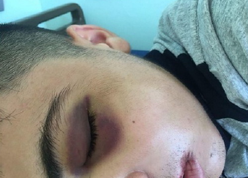Un elev a fost operat la maxilar după ce a fost lovit de un coleg, într-un liceu din Craiova
